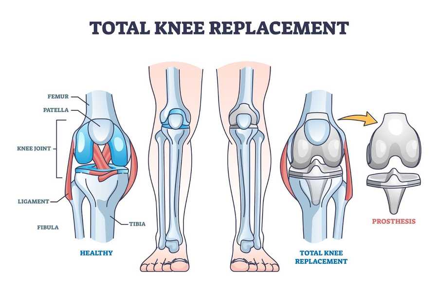 What is knee replacement surgery