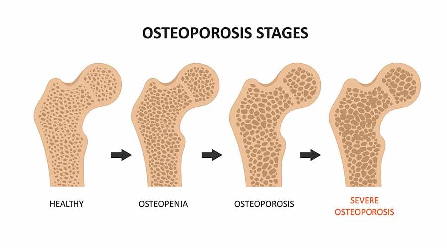 What is osteopenia