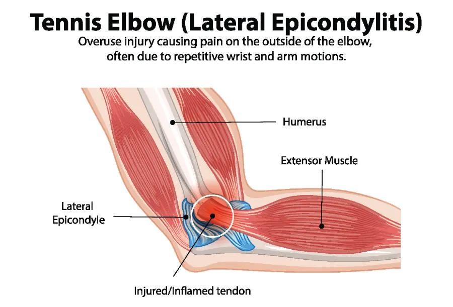 tennis elbow