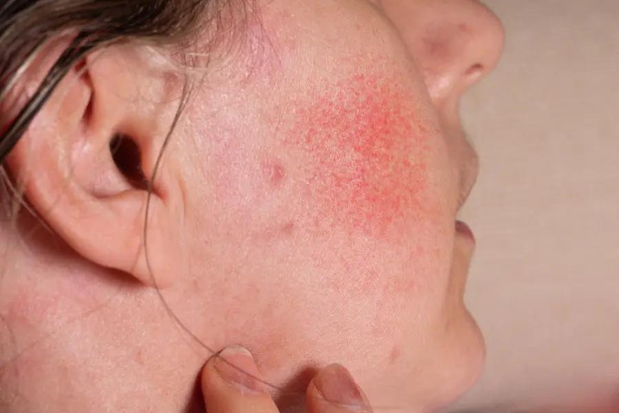 What are the symptoms of rosacea